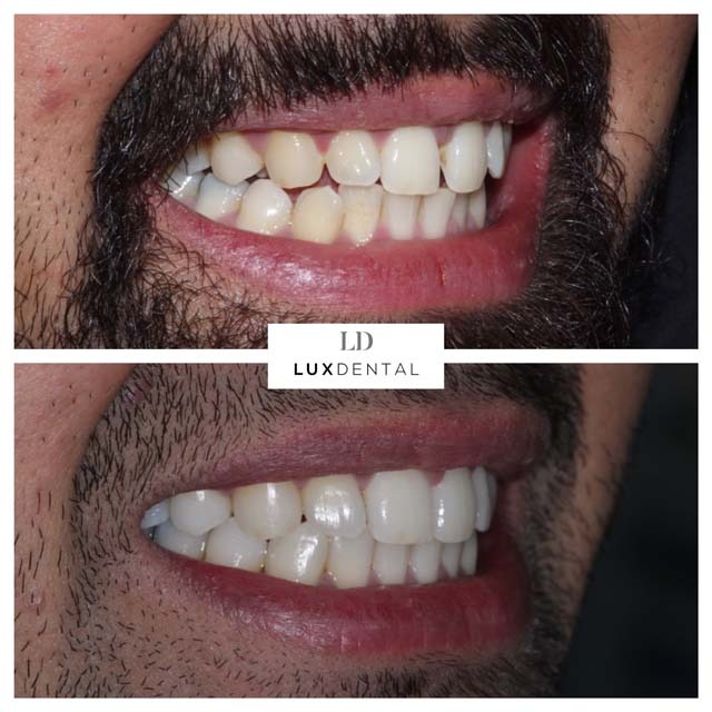 Invisalign® before after