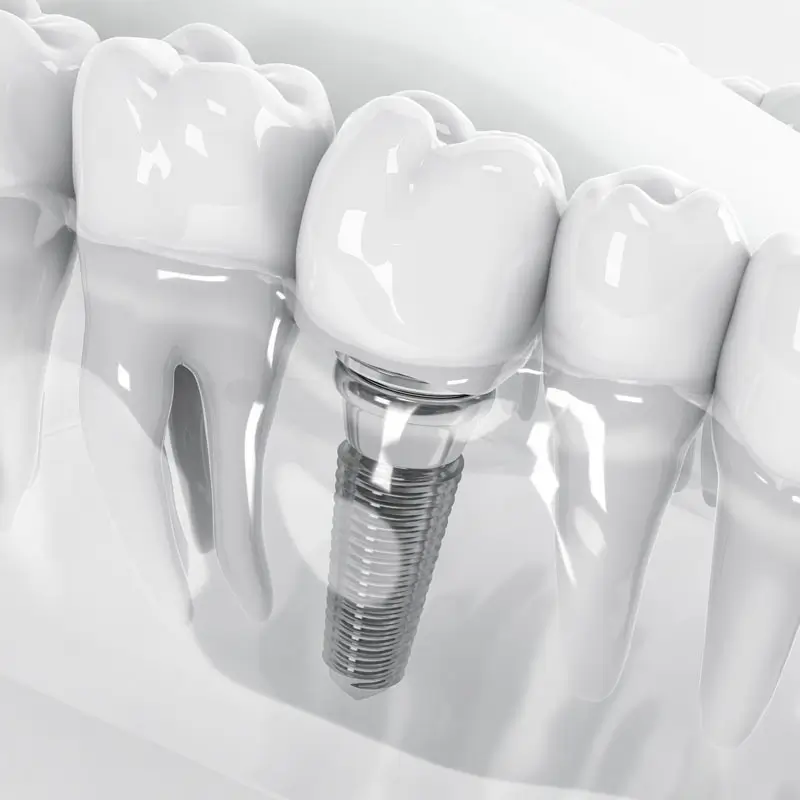 All implants are not the same