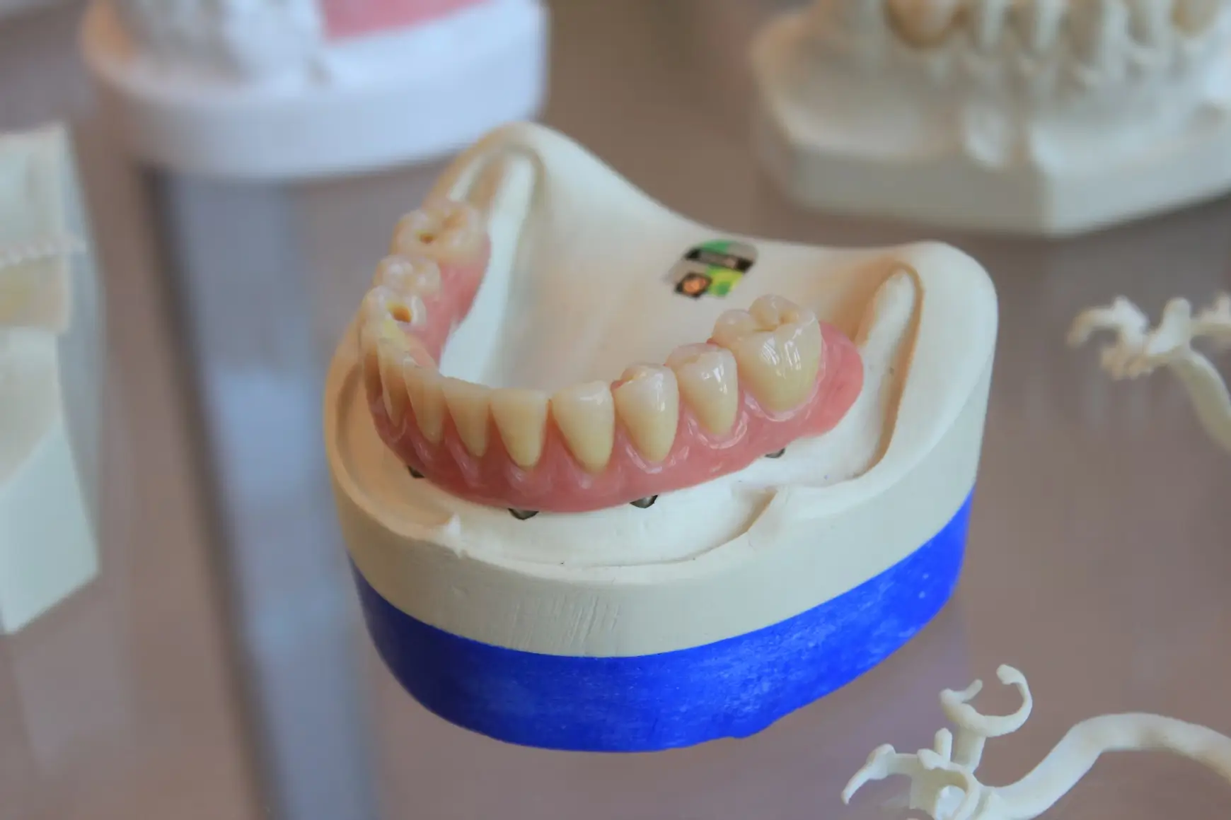 Implant Supported Dentures