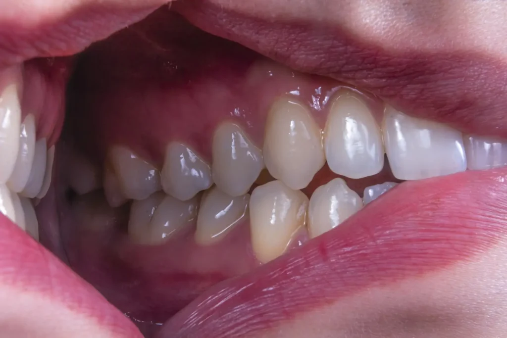 Small or peg-shaped teeth