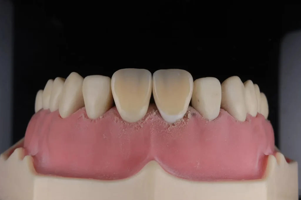 Uneven Tooth Shape