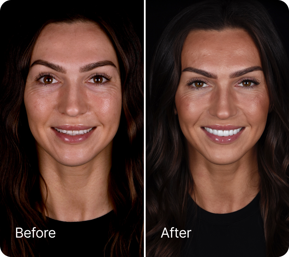 Before and after veneers result