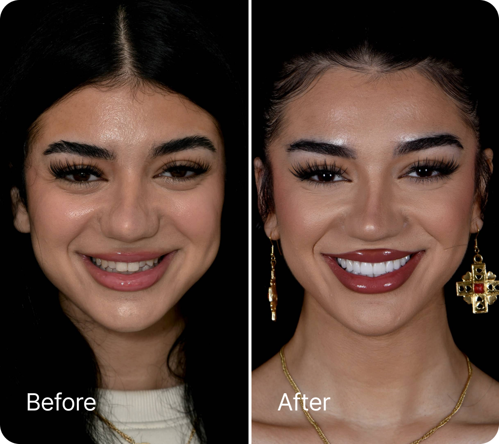 Before and after veneers result