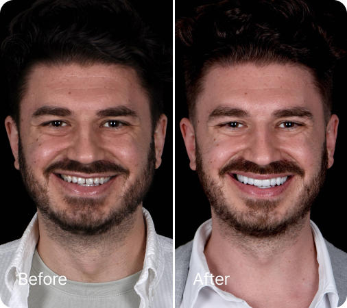 Before and after veneers result