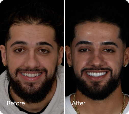 Before and after veneers result