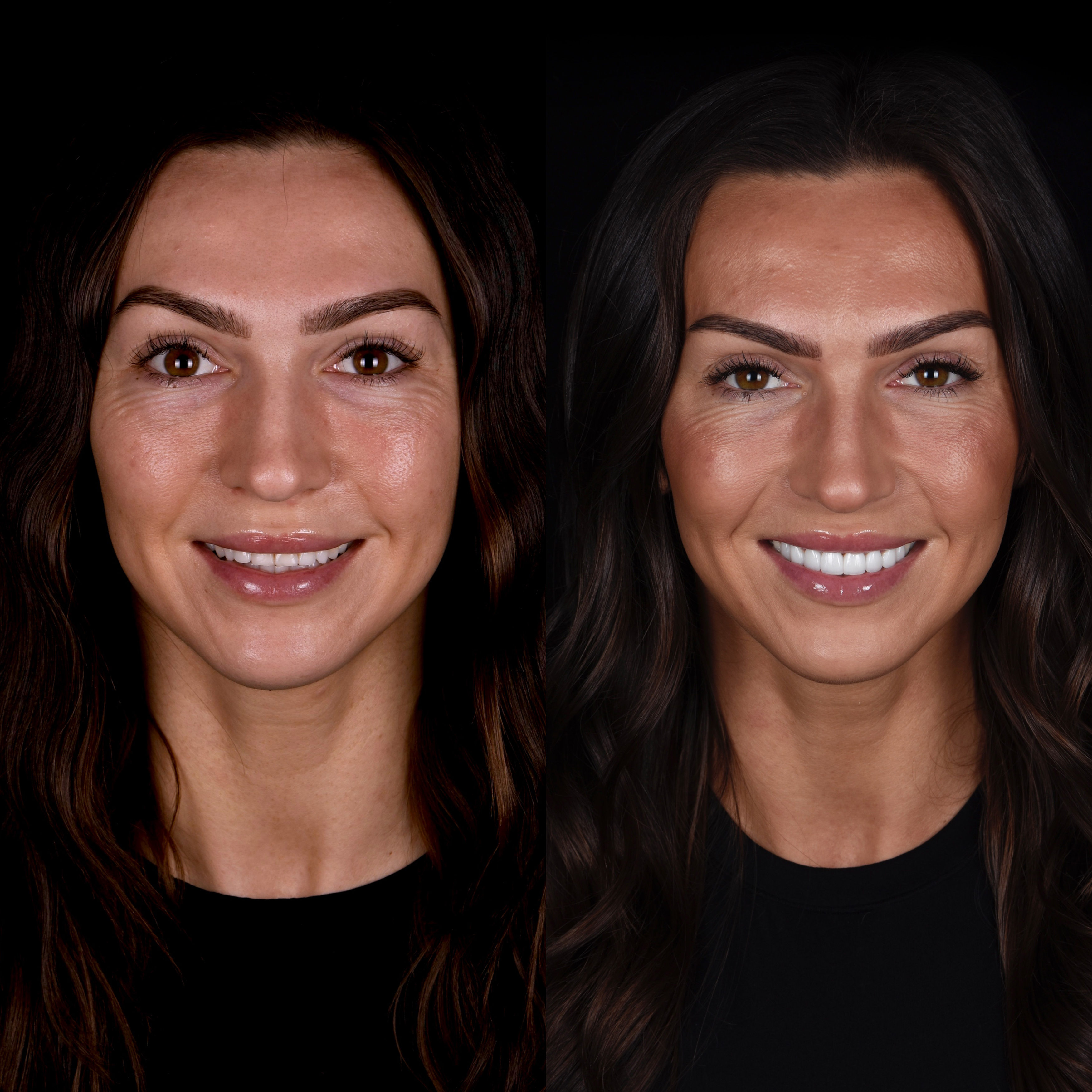 Before and after veneers result