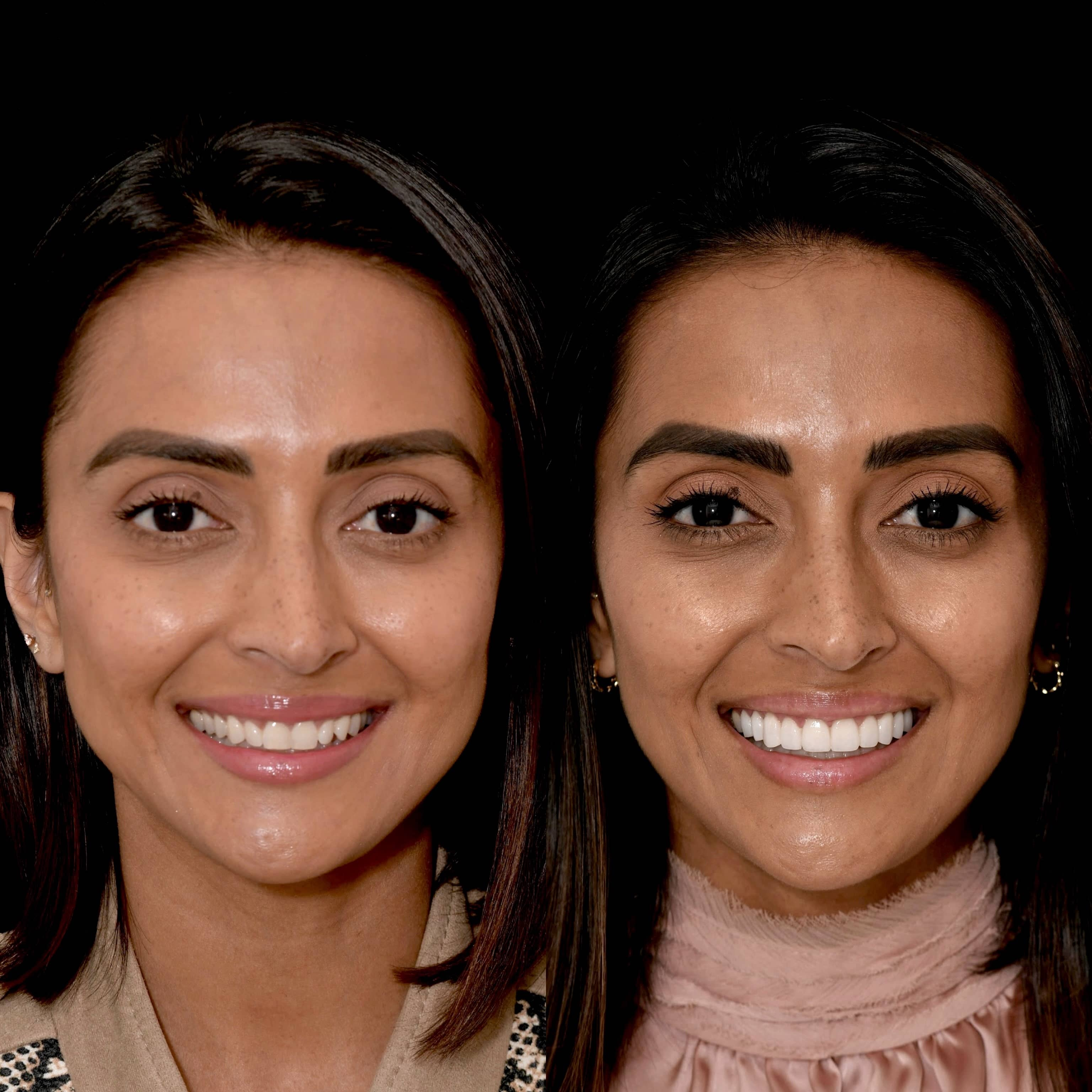 Patient smiling after veneers treatment